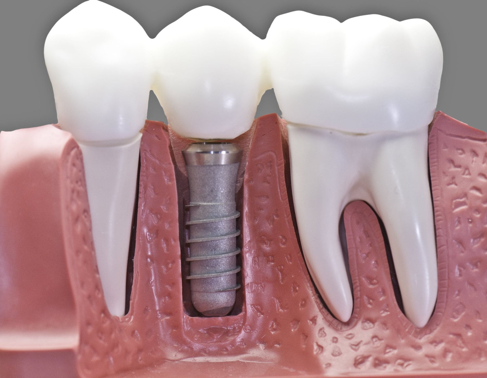 Beyond Your Smile Dental Implants