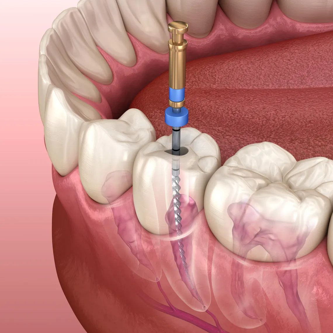 Root Canal los Angeles CA