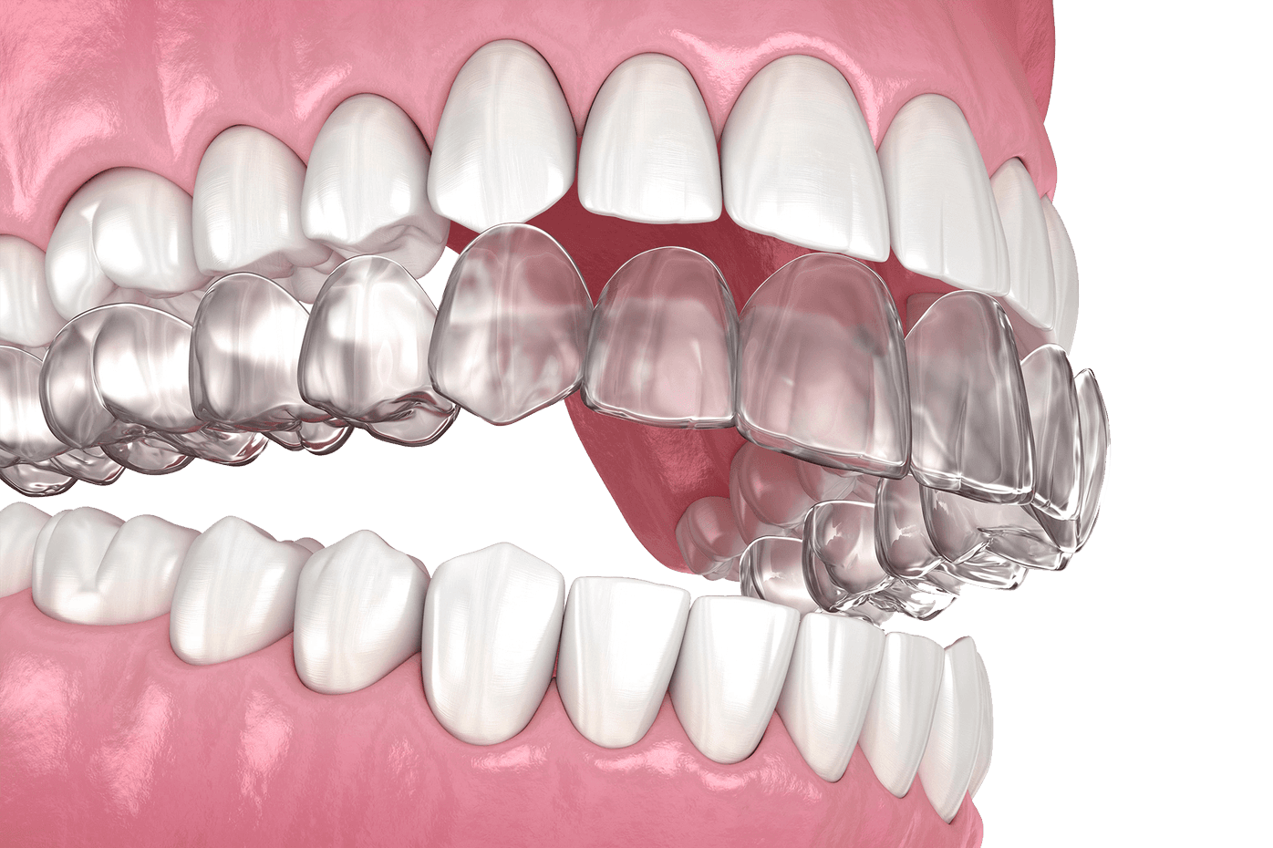 Invisalign in Chinatown, NYC