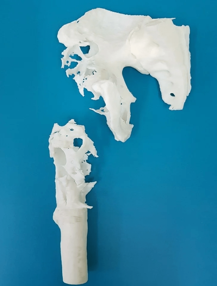 3д ендропротез